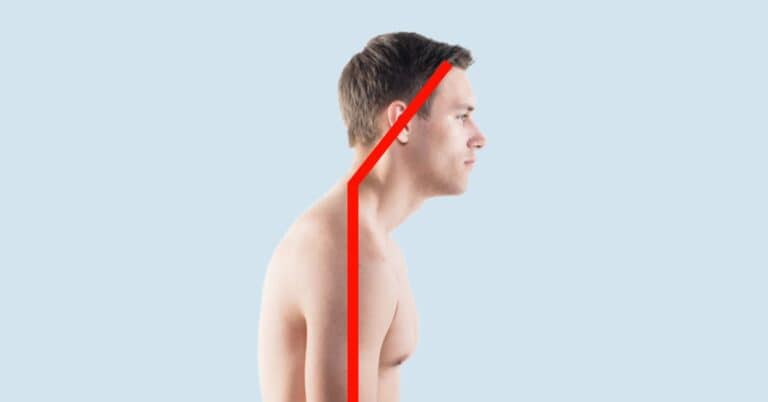 forward head posture